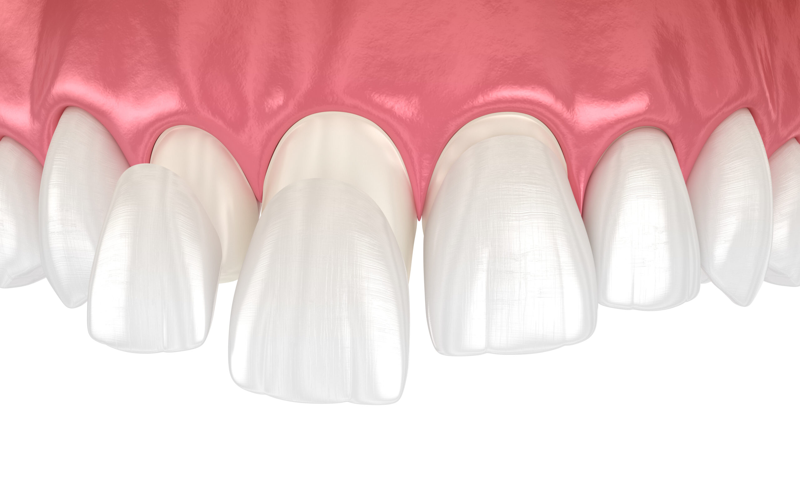Porcelain veneers at Shore Drive Dental