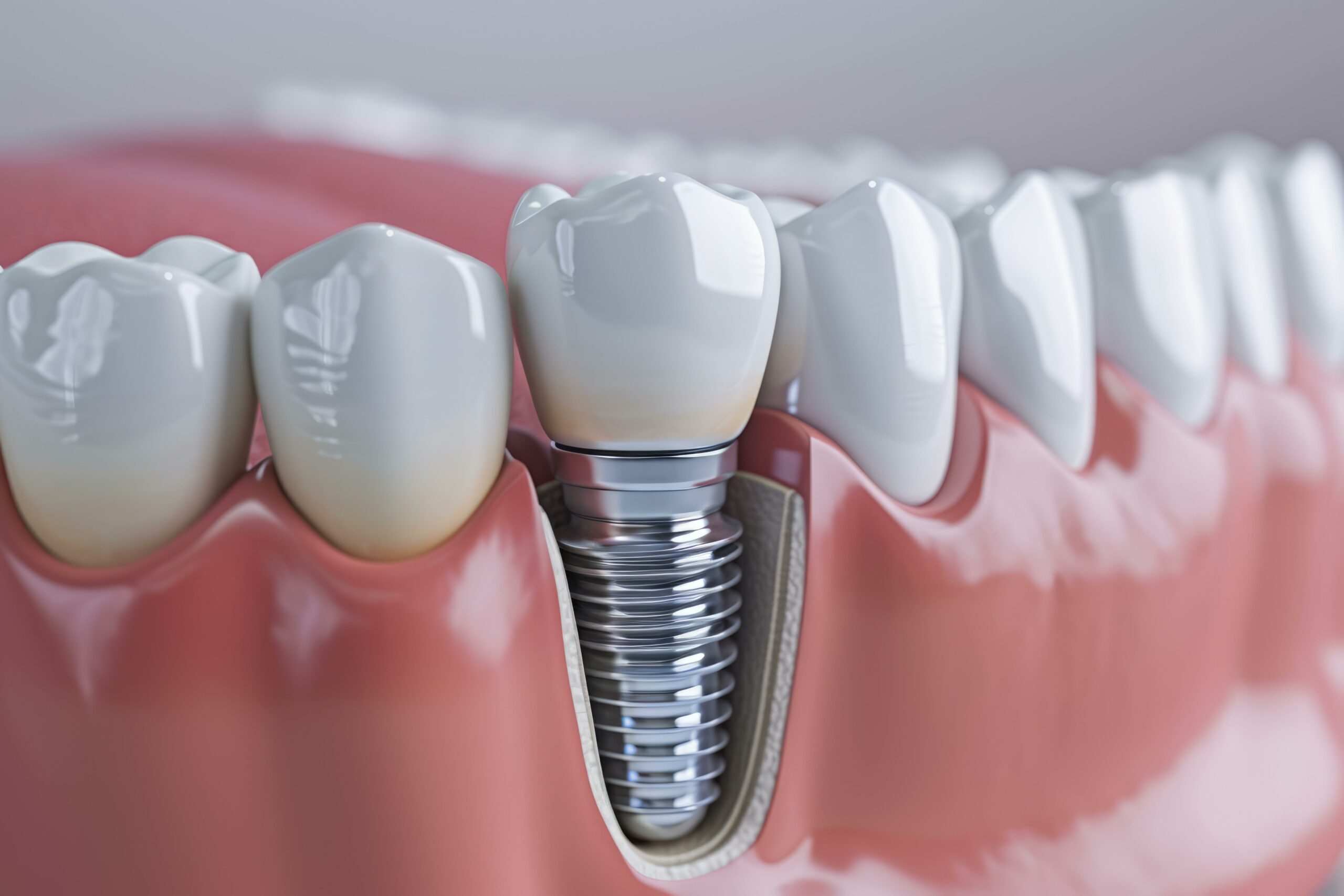 Dental implant placement at Shore Drive Dental