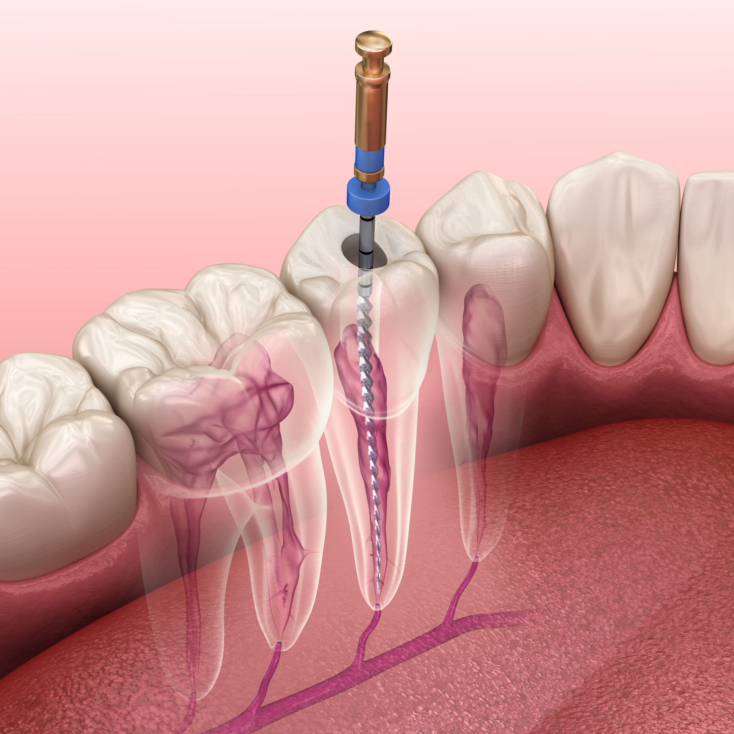 Root canal therapy at Shore Drive Dental