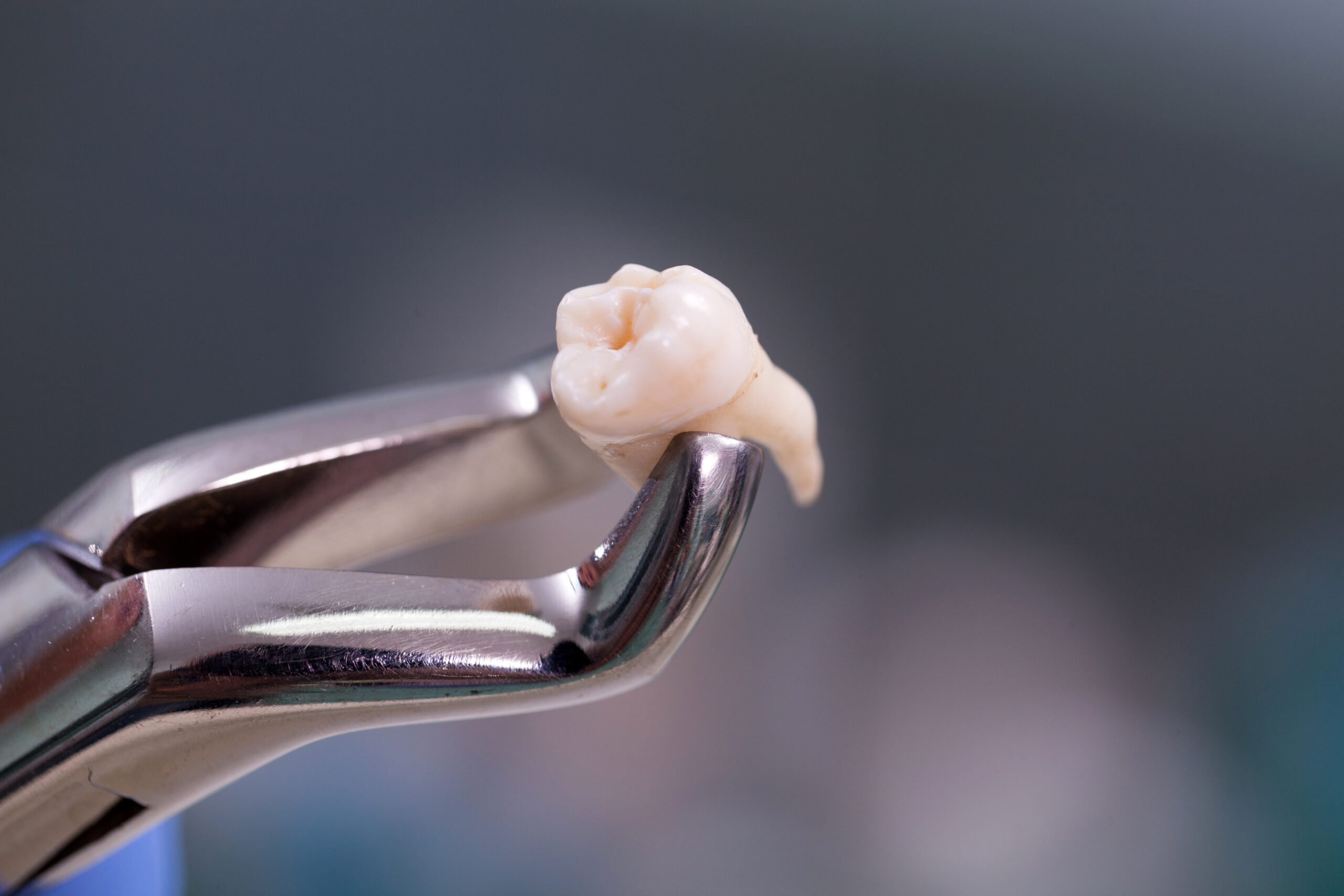 Gentle tooth extractions at Shore Drive Dental